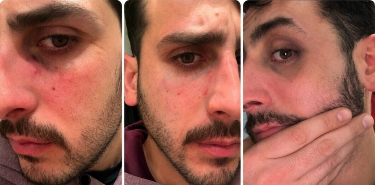 clarincom's tweet photo. LOS AUDIOS Y MENSAJES DEL JOVEN ASESINADO POR SU NOVIA

Lectura rápida
A tres días del crimen de Julián Álvarez Guardia (29), comenzaron a conocerse audios, mensajes e imágenes en los que el joven relataba episodios de violencia durante su relación con Victoria Luz Cantero (25). Familiares y amigos aseguran que le pedían que terminara el vínculo y que incluso le habían advertido que podía resultar gravemente herido.

La versión de la defensa
El abogado de Cantero sostuvo que la joven presenta marcas producto de una pelea y cuestionó la hipótesis de que hubiera atacado a Julián mientras dormía. Además, afirmó que la confesión ocurrió durante un interrogatorio que considera irregular.

Testimonios

“¿Y qué podíamos hacer? ¡Sabés las veces que le decíamos que esta mina es una persona violenta y manipuladora... y que lo iba a terminar lastimando! Él estaba hasta las manos, pero la sufría mucho, porque lo cagaban a palos, pero así, con todo lo que ella le hizo, él la amaba”. — Amigo de la víctima.

“Qué sé yo, amigo, no tengo idea. La camioneta es lo de menos, el tema es todo lo que me pegó, boludo. Y me rompió la cadenita de tanto que me estaba tirando... Es una banda ya, está re mal, me revisa el teléfono y me pone una foto juntos en mi perfil”. — Julián Álvarez Guardia, en un audio enviado a un amigo.

“A mí me contaba todo, cada discusión, cada pelea, cada separación, cada reconciliación. Era una película repetida y yo le vivía diciendo que la cortara de una vez... Pero no sólo yo, eh, el grupo de amigos bancaba a full a este tipazo, pero en esta relación estaba perdido, ella lo manejaba como quería. En una ocasión, después de uno de los tantos ataques de ella, yo le tiré que lo iba a terminar acuchillando. Ahora, con los hechos, no lo puedo creer”. — Amigo de la víctima.

“Me pega seguido”, “me maltrata”, “me grita siempre”, “me manda al psicólogo”, “estoy cansado, pero ya lo normalicé”. — Mensajes atribuidos a Julián Álvarez Guardia.

“Una vez los padres de Victoria hablaron a solas con Juli y le pidieron por favor y en buenos términos que la dejara, que no volviera más, porque ellos notaban la violencia que expresaba su propia hija. A lo sumo se separaban un par de semanas, un mes a lo sumo, y volvía y mi hermano se abría cada vez más. No sólo le daba las claves de su teléfono y de sus redes, sino también las llaves de su casa. Hoy creo que él le tenía miedo a ella, o a sus brotes de locura”. — Leticia Álvarez Guardia, hermana de Julián.

“Juli nos decía que se aguantaba todo, que no reaccionaba nunca, que jamás le levantaría la mano a su novia. Para mí ella lo provocaba para que él reaccionara y, luego, denunciarlo por violencia de género. Yo estaba convencida de que ella iba a inventar algo de ese tipo, pero esto no estaba en la imaginación de nadie”. — Leticia Álvarez Guardia.

“Era una relación adictiva, evidentemente. Un dolor en el alma, porque Juli tenía todo para tener una relación sana como ya había tenido, pero no supo, no pudo zafar”. — Leticia Álvarez Guardia.

(+) en Clarín: https://t.co/CASA2tNvBn