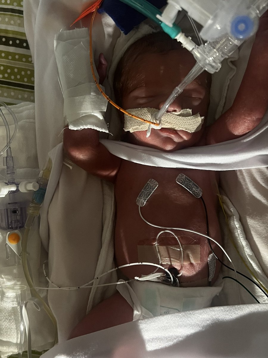 elliottengenMN's tweet photo. Minnesota law currently allows anyone, for any reason, to kill a baby- up to 40 weeks gestation.

This is my son- born at 28wks. 

30 minutes before this picture was taken, he had zero human rights. 

The only places on Earth he had none? Iran, North Korea, and Minnesota. https://t.co/bSHRV6KcS7