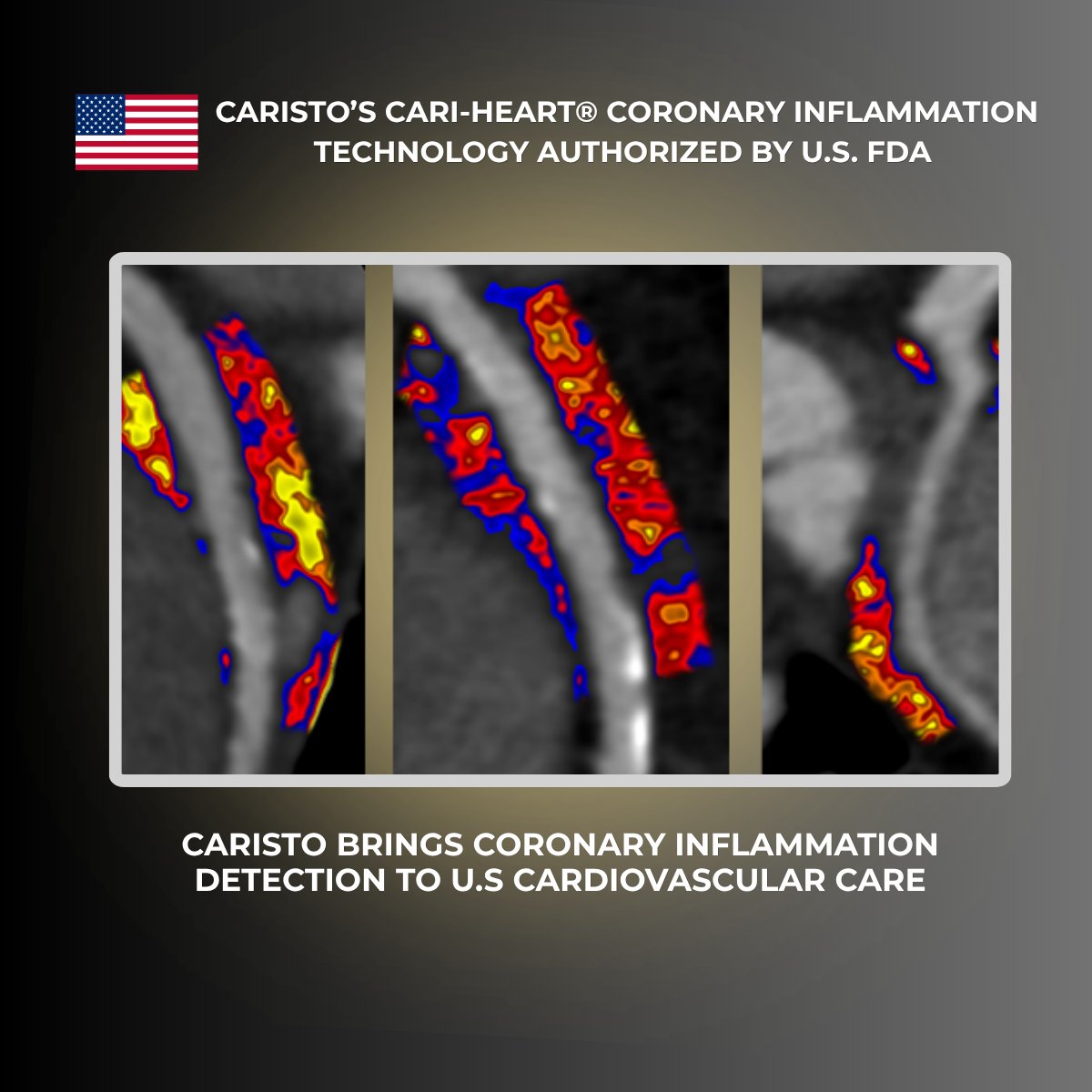 CaristoHeart's tweet photo. Caristo’s CaRi-Heart® debuts in the U.S.! A landmark moment for #cardiovascularcare — and a major win for science, clinicians, and patients!  🎉CaRi-Heart has received U.S. FDA De Novo authorization, becoming the first and only technology authorized in the U.S. to detect and quantify coronary inflammation from routine coronary CT angiography (CCTA).  

This milestone reflects more than a decade of pioneering science, relentless work, and shared belief in a future where cardiovascular disease can be detected earlier, treated more personally, and patients can live longer, healthier lives.  

Read the full announcement: https://t.co/bhwzypkL6D #CaRiHeart #CaristoDiagnostics #CoronaryInflammation #FAIScore #PreventiveCardiology #CardiacCT #AIinHealthcare #MedTech #FDA #Cardiology