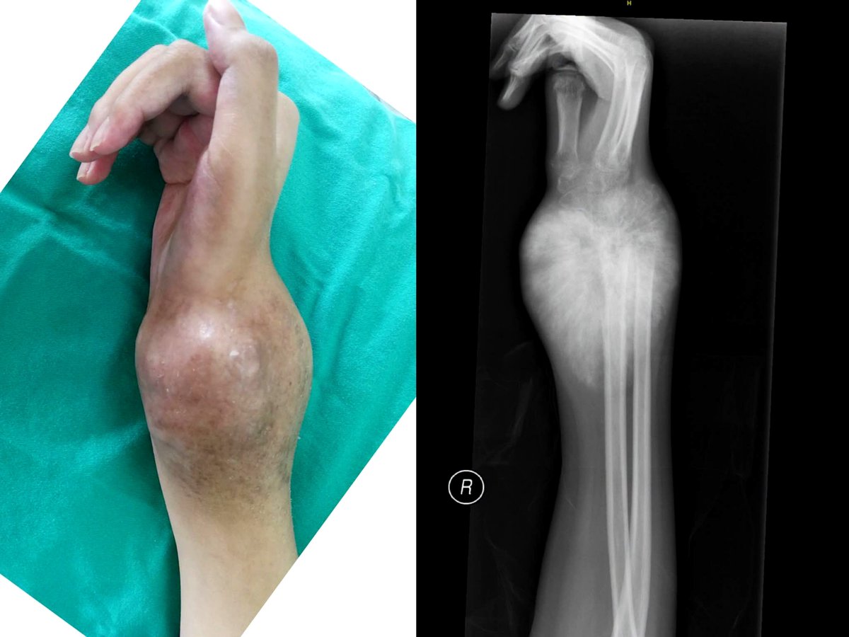 DrNaseemSuhail's tweet photo. A 15-year-old girl has 6 months of worsening right wrist pain, a rapidly enlarging wrist swelling, restricted wrist movement, and weight loss. 

Based on the clinical photo and X-ray, what is the most likely diagnosis? https://t.co/fcR7c3WpSF