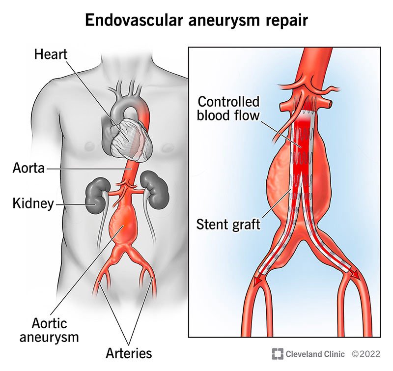 Si_Jade_'s tweet photo. ไม่ใช่หมอเส้นเลือด แต่ขอขยายความเจ้าของโพส 

ตองA หรือ Abdominal aortic aneurysm (AAA) = หลอดเลือดแดงใหญ่ในท้องโป่งพอง 
นึกภาพเป่าลูกโป่ง พอมันโป่งถึงระดับนึงผนังบาง ความเสี่ยงแตกสูงขึ้นมาก 
ถ้าตองAแตก = ตายห่าแน่นอน

การรักษาก็คือ��่าตัดซ่อมมันซะ 
เมื่อก่อนมันต้องผ่าเปิดท้อง

/1 https://t.co/sIxy30awep