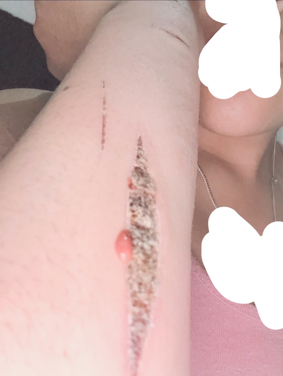 mumsomii's tweet photo. this where we at.
fake fake fake
sfx fake
movie makeup wtv
#update #fyp #viral #shtwt #healing https://t.co/YHZYrPPX6L