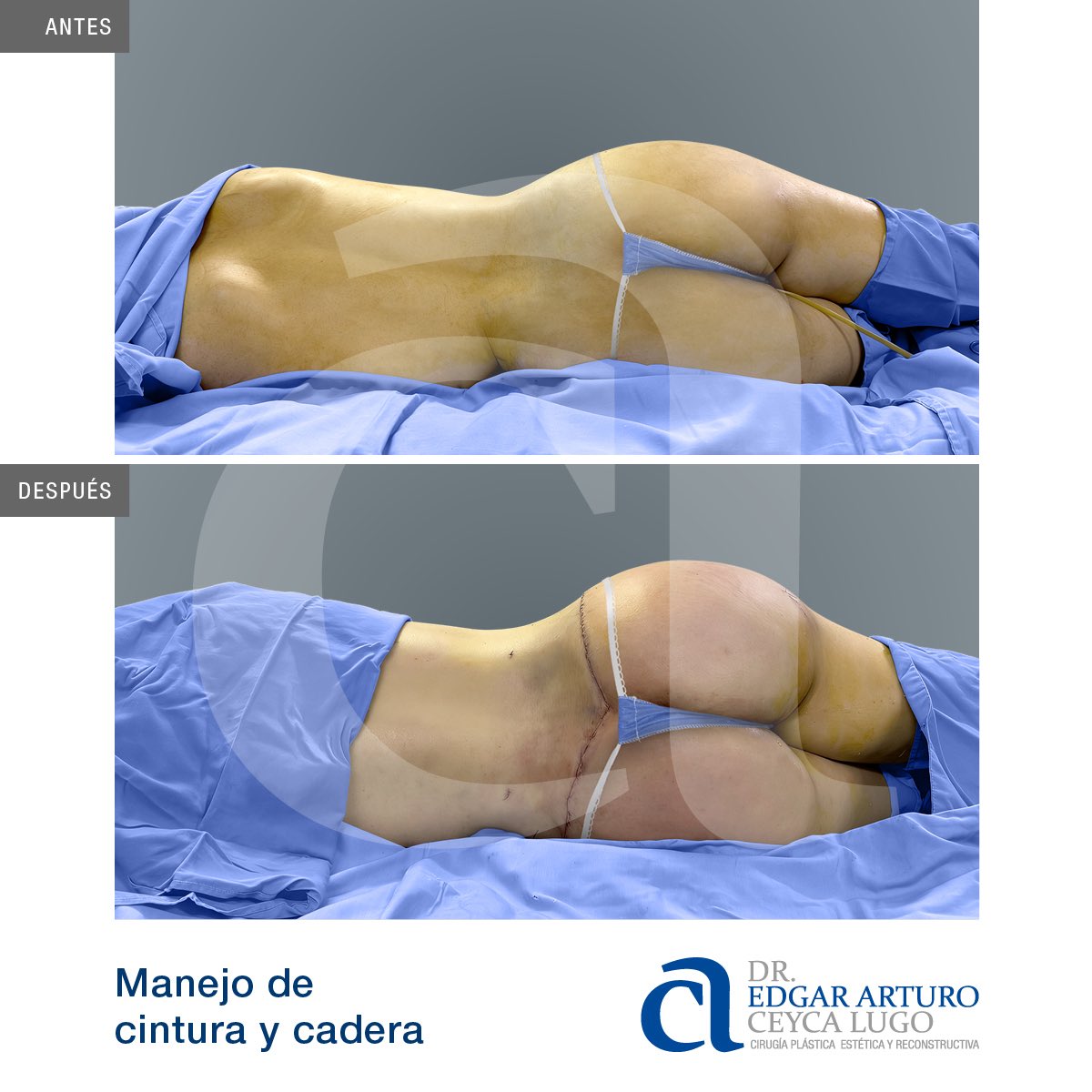 ArturoCeyca's tweet photo. Abdominoplastia Circular y Lipoescultura.
(Armonización y Manejo de Cintura y Cadera)
https://t.co/BNl0E9HKjU
CITAS
🇲🇽Culiacán-Tijuana, México
☎️ 6671429074 (9am - 8pm)
📞 6673160917 (8am - 8pm)
#cirugiaplastica #cirujanoplastico #plasticsurgery #liposuccion #lipoescultura https://t.co/Zbdq6Ls3Cb