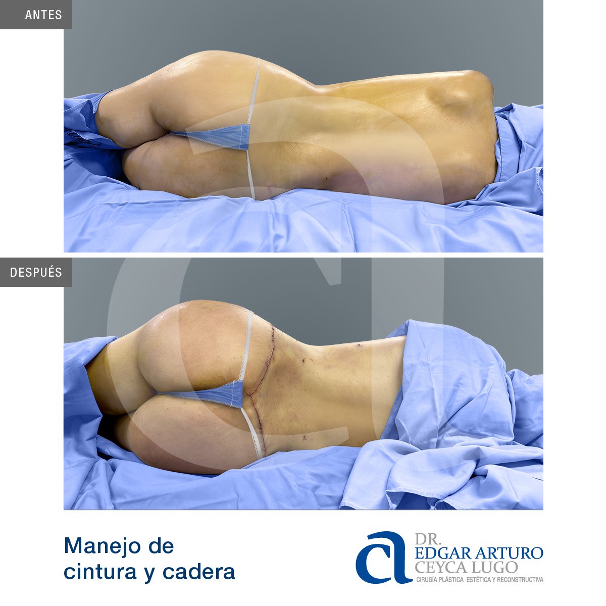 ArturoCeyca's tweet photo. Abdominoplastia Circular y Lipoescultura.
(Armonización y Manejo de Cintura y Cadera)
https://t.co/BNl0E9HKjU
CITAS
🇲🇽Culiacán-Tijuana, México
☎️ 6671429074 (9am - 8pm)
📞 6673160917 (8am - 8pm)
#cirugiaplastica #cirujanoplastico #plasticsurgery #liposuccion #lipoescultura https://t.co/Zbdq6Ls3Cb
