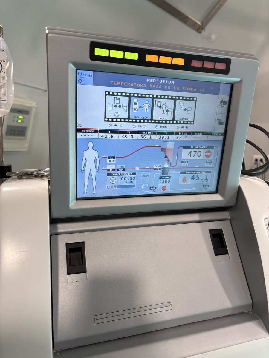 MIsabelPrieto2's tweet photo. Tras obtener la acreditación para el uso de TNFa, hemos realizado en el Hospital la Paz, la cuarta perfusion aislada de MMII. Una técnica que permite mejorar la calidad de vida y evitar la amputacion en muchos casos. Gracias a todos los que lo habéis hecho posible @HULPSurgery https://t.co/LOSZ7nJGV6