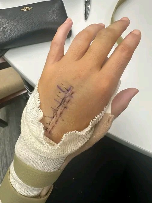 Masindii_'s tweet photo. My surgery hand went well ❤️😭 https://t.co/fIXlFOYHnT
