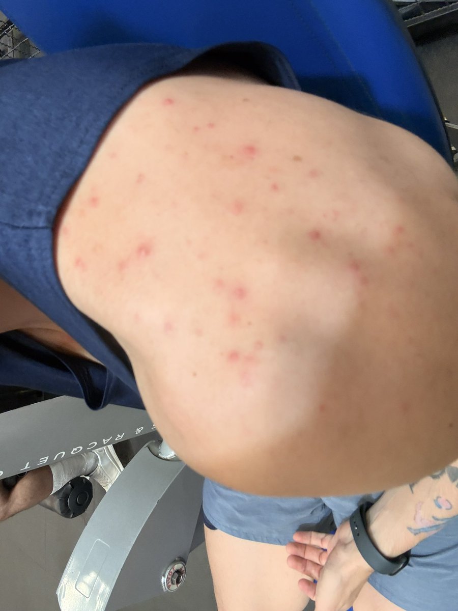 Herculanito0's tweet photo. @alxgzar Mal como? Es normal tener reacción como acne los primeros días.. yo retomé el tratamiento y me pasó ésto. Usé un jabón para acné y me lo mejoró https://t.co/LGxoNrvAdg