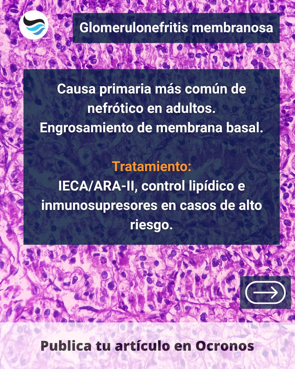 revistaocronos's tweet photo. Glomerulonefritis membranosa: no todo nefrótico adulto es igual  
Depósitos subepiteliales de IgG y C3 con engrosamiento de membrana basal.  
Guárdalo para repaso rápido 🔬 #Nefrología #Medicina https://t.co/tOFC5yvAmw