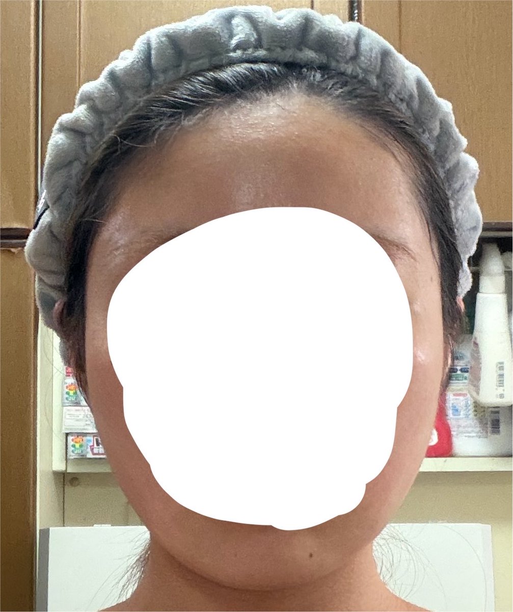 0cm_rice's tweet photo. 頬顎下脂肪吸引DT2週間😭💞 https://t.co/K07DOyv2cR