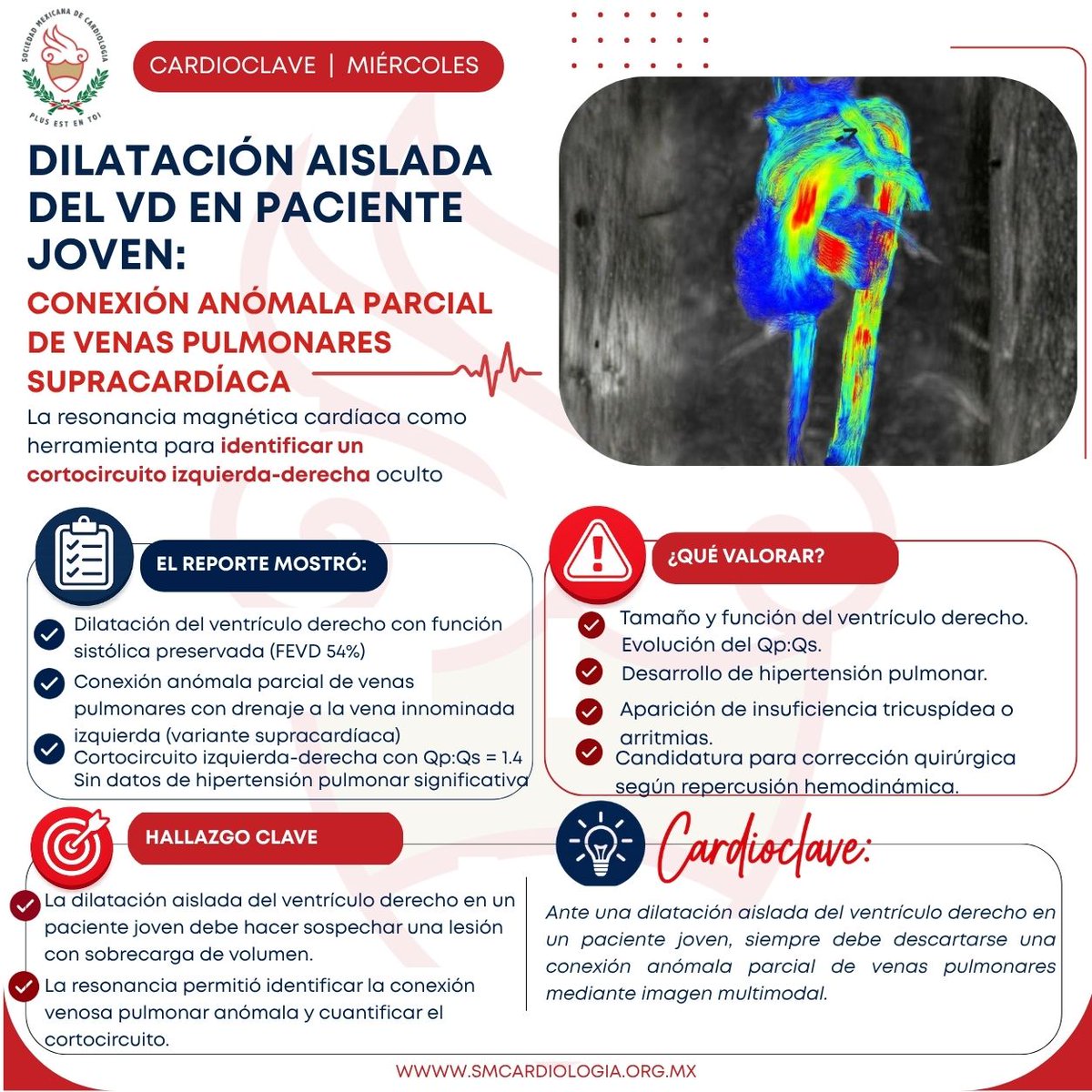 smexcardiologia's tweet photo. #CardioClave 🫀
La dilatación aislada del ventrículo derecho en un paciente joven debe despertar la sospecha de una lesión con sobrecarga de volumen. En este caso, la resonancia magnética cardíaca permitió identificar una conexión anómala parcial de venas pulmonares supracardíaca y cuantificar el cortocircuito izquierda-derecha.
🔎 CardioClave: Ante una dilatación aislada del ventrículo derecho en un paciente joven, siempre debe descartarse una conexión anómala parcial de venas pulmonares mediante imagen multimodal.
📚 Contenido elaborado por:
@axel.hernandez.923 | Dr. Axel H. Hernández Pineda
@cecimatheus | Dra. Cecilia Matheus
@salmalotfe | Dra. Salma Harisa Lotfe Ordeñas
@lilin4l | Dra. Liliana Zarco García
#CardioClave #Miércoles #Cardiología #ResonanciaMagnéticaCardíaca #ImagenCardiovascular