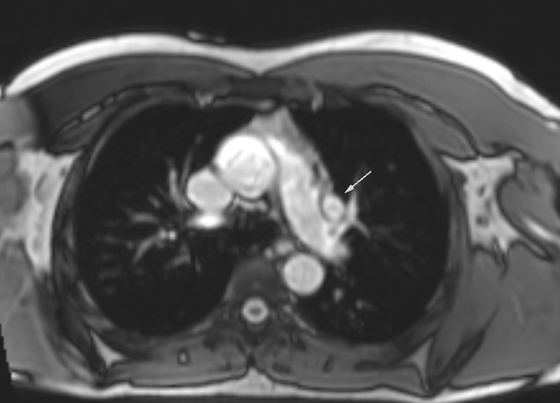 smexcardiologia's tweet photo. #CardioClave 🫀
La dilatación aislada del ventrículo derecho en un paciente joven debe despertar la sospecha de una lesión con sobrecarga de volumen. En este caso, la resonancia magnética cardíaca permitió identificar una conexión anómala parcial de venas pulmonares supracardíaca y cuantificar el cortocircuito izquierda-derecha.
🔎 CardioClave: Ante una dilatación aislada del ventrículo derecho en un paciente joven, siempre debe descartarse una conexión anómala parcial de venas pulmonares mediante imagen multimodal.
📚 Contenido elaborado por:
@axel.hernandez.923 | Dr. Axel H. Hernández Pineda
@cecimatheus | Dra. Cecilia Matheus
@salmalotfe | Dra. Salma Harisa Lotfe Ordeñas
@lilin4l | Dra. Liliana Zarco García
#CardioClave #Miércoles #Cardiología #ResonanciaMagnéticaCardíaca #ImagenCardiovascular