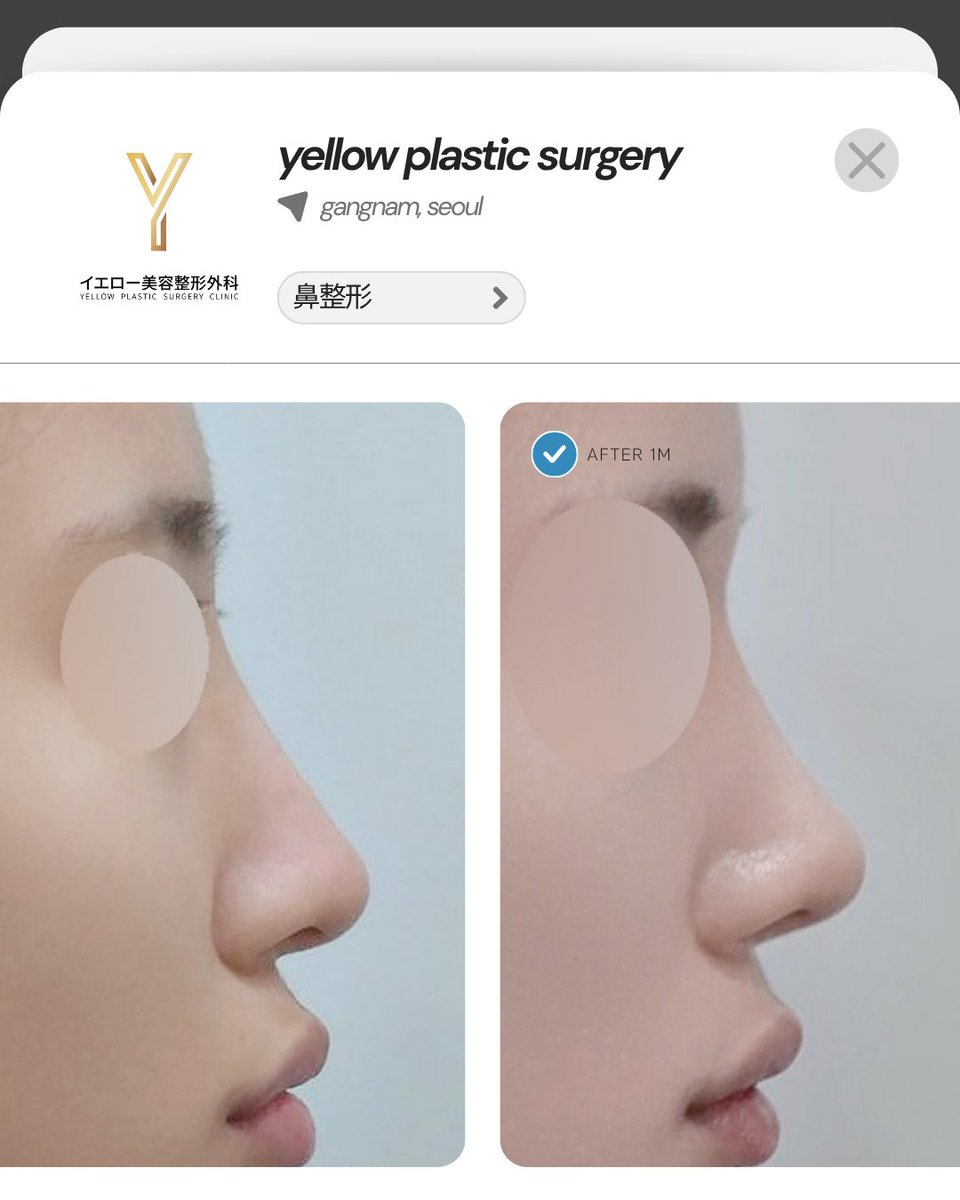 yellowpsjp's tweet photo. イエロー症例💛

・手術内容
鼻の再手術
鼻筋：プロテーゼ
鼻先：鼻尖形成（鼻中隔軟骨、耳介軟骨、寄贈肋軟骨）

✔日本語担当者常住
✔カンナム駅すぐ前
✔腫れケア制限無し

【韓国】イエロー美容整形外科
📍ソウル市江南区江南大路406, GLASS TOWER 5F
📲お問い合わせ：https://t.co/p4KIdNVfvV https://t.co/rJBHnBIaco