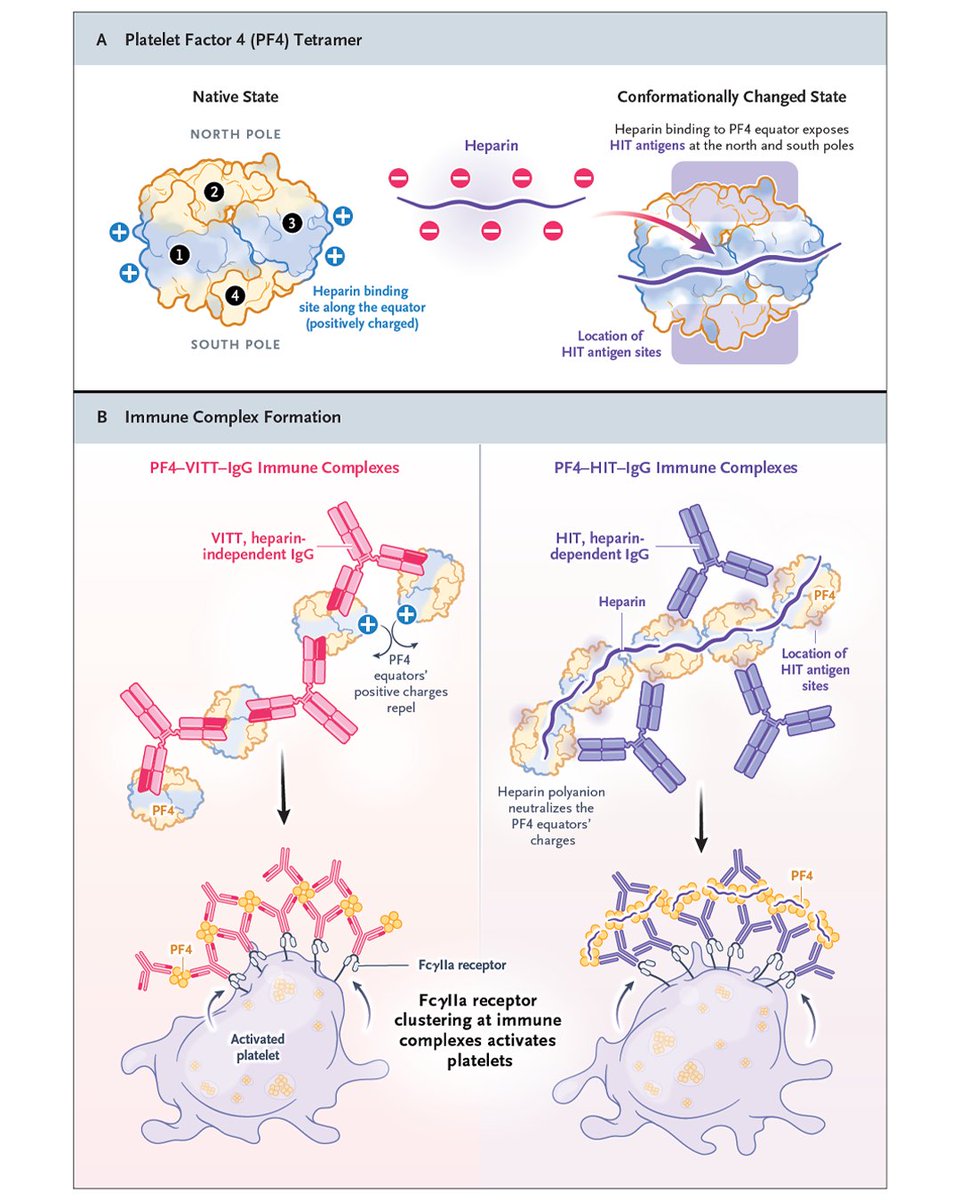 NEJM's tweet photo. 𝗥𝗲𝘃𝗶𝗲𝘄 𝗔𝗿𝘁𝗶𝗰𝗹𝗲: 𝗣𝗹𝗮𝘁𝗲𝗹𝗲𝘁-𝗔𝗰𝘁𝗶𝘃𝗮𝘁𝗶𝗻𝗴 𝗔𝗻𝘁𝗶–𝗣𝗹𝗮𝘁𝗲𝗹𝗲𝘁 𝗙𝗮𝗰𝘁𝗼𝗿 𝟰 𝗗𝗶𝘀𝗼𝗿𝗱𝗲𝗿𝘀 

Platelet-activating antibodies against platelet factor 4 (PF4) cause highly prothrombotic disorders with reduced platelet counts. In heparin-induced thrombocytopenia (HIT), these antibodies bind PF4–heparin complexes, causing heparin-dependent platelet activation. Less common autoimmune and spontaneous HIT variants that are triggered by heparin and nonpharmacologic polyanions, respectively, have atypical clinical features and antibodies with additional heparin-independent platelet-activating properties. Vaccine-induced immune thrombocytopenia and thrombosis (VITT) antibodies directly target PF4. Initially, VITT was linked to adenoviral vector–based coronavirus disease 2019 vaccines, but in rare cases, an immune thrombocytopenia and thrombosis disorder that is clinically nearly identical to VITT can be caused by infection resulting from natural exposure to viruses, especially adenovirus. In persons with the IGLV3-21*02/*03 gene, anti–adenovirus protein VII antibody specificity shifts to PF4 by way of a specific somatic hypermutation (K31E) that creates VITT antibodies. In VITT-like monoclonal gammopathy of thrombotic significance, monoclonal anti-PF4 antibodies cause chronic prothrombotic conditions. Accurate diagnosis relies on distinct assays for HIT and VITT antibodies. Beyond anticoagulation, inhibition of FcγIIa receptor–mediated platelet activation may be needed for anti-PF4 disorders with heparin-independent reactivity (e.g., high-dose immune globulin in acute disease manifestations and Bruton’s tyrosine kinase inhibitors in chronic manifestations). 

Learn more in the Review Article “Platelet-Activating Anti–Platelet Factor 4 Disorders” by Theodore E. Warkentin, MD, and Andreas Greinacher, MD: https://t.co/5mnvrPal1Z