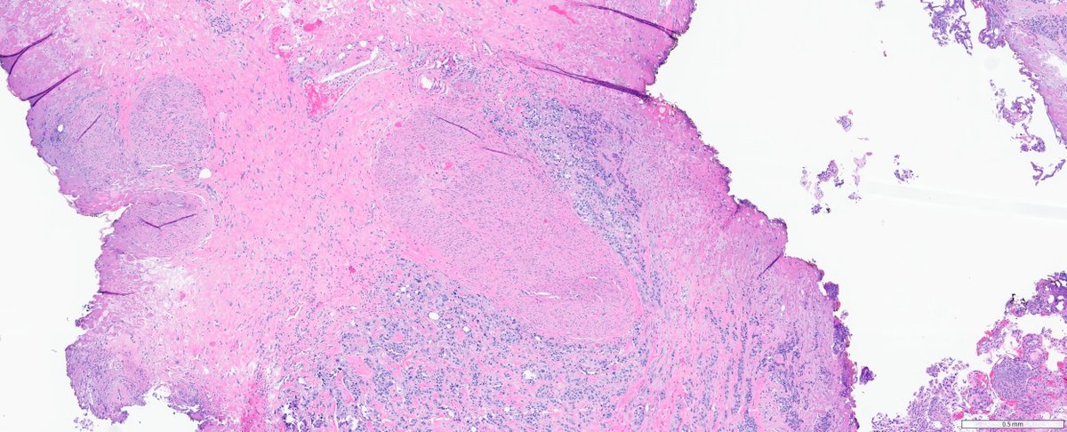 slusagar's tweet photo. #GUpath TURBT from today's signout showing what I call "3/4 rule" of MP invasion

(if tumor is three-quarters of the way around MP bundle but not technically IN bundle, I'll still call it MP invasion)

for good measure, lower power shots show more typically pattern MP invasion https://t.co/DCuAP5uezj