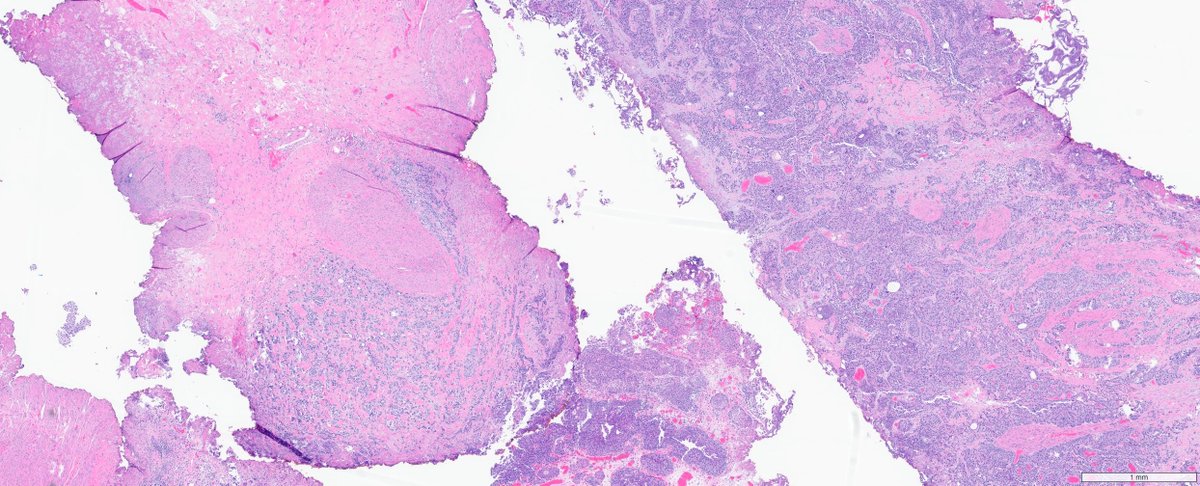 slusagar's tweet photo. #GUpath TURBT from today's signout showing what I call "3/4 rule" of MP invasion

(if tumor is three-quarters of the way around MP bundle but not technically IN bundle, I'll still call it MP invasion)

for good measure, lower power shots show more typically pattern MP invasion https://t.co/DCuAP5uezj