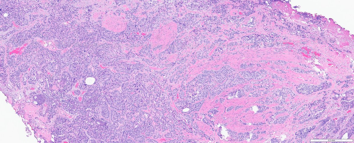 slusagar's tweet photo. #GUpath TURBT from today's signout showing what I call "3/4 rule" of MP invasion

(if tumor is three-quarters of the way around MP bundle but not technically IN bundle, I'll still call it MP invasion)

for good measure, lower power shots show more typically pattern MP invasion https://t.co/DCuAP5uezj
