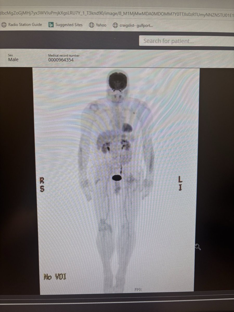 StacyLDriscoll1's tweet photo. @harryfisherEMTP @Aquamariah1 This is what turbo cancer looks like . 3 months between scans. This is my husband. https://t.co/nCrl2KjZn6