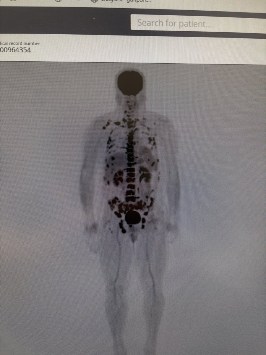 StacyLDriscoll1's tweet photo. @harryfisherEMTP @Aquamariah1 This is what turbo cancer looks like . 3 months between scans. This is my husband. https://t.co/nCrl2KjZn6