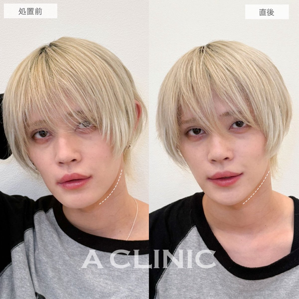 ACLINICSHINJUKU's tweet photo. \\ メンズ美容ならAクリニック新宿院 //

メンズも美容が当たり前の時代。
「自分も何か始めたいけど何からしたらいいか分からない💧」
そんな方でも大歓迎🙆🏻◎

患者様に必要で最適なお施術のご提案をさせていただきます✨✨
相談のみでももちろんOK！

↓今ならここからの予約で2万ポイント貰えます https://t.co/MBwrznLns4