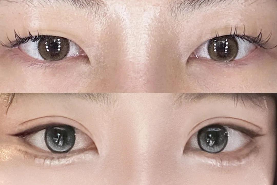 dressjp's tweet photo. ˚*.꒰   症例写真   ꒱.*˚
 
#自然癒着 × #目付き矯正 💖

自然癒着 × 目付き矯正 で、目が軽く開くようにし、黒目がしっかり見えるように👀
広すぎる二重幅から自然なミックス型にすることでくっきりとした二重に！

イベント価格で学生でも安心✨💍

目の再手術はぜひ #ドレス で！ https://t.co/AywlUlW4rp