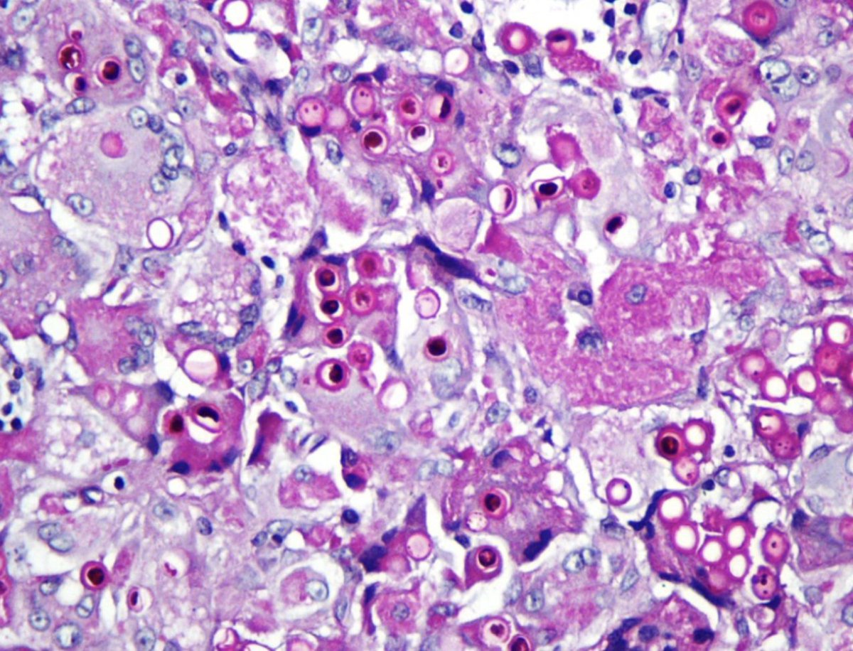 ChristineJKoMD's tweet photo. beautiful images #dermatology #pathology #dermpath https://t.co/nmJIzaf6Au @JAMADerm https://t.co/x468EV4Ykt