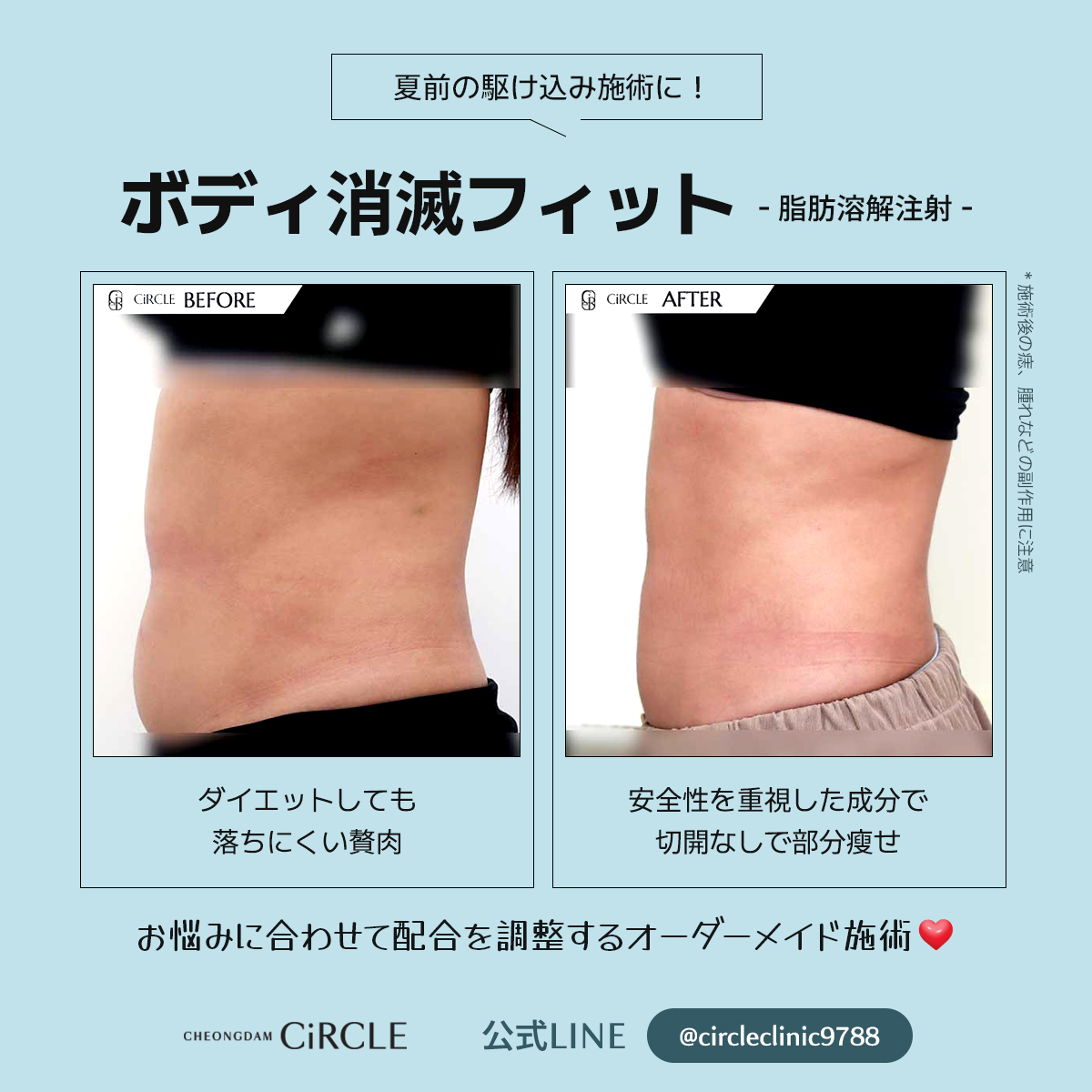 shwclinic1's tweet photo. 努力で変えにくい部分こそオーダーメイドに。

チョンダムサークルのボディ消滅フィットは
悩みに合わせて薬剤を調整し
気になる部分へアプローチする脂肪溶解注射💉

ステロイド・PPC不使用でDT最小限🩵

無理なダイエットではなく、
賢く部分痩せという選択を。

🔍お問合せ
https://t.co/qZxm6ysFfr https://t.co/zuu6tEkpiv