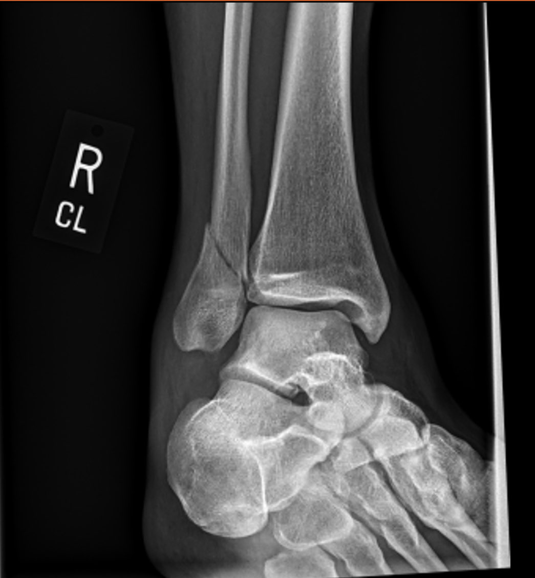 ellevatorlady's tweet photo. Also i lost my job then I broke my leg and walked on it for a week before I realize it was more than a sprain so now I am punished stelio stuck in a boot https://t.co/2fIPLKWoXt
