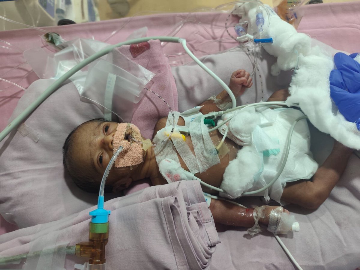 TrendsAlluArjun's tweet photo. 🚨 Urgent Help Needed 🚨

A newborn baby is fighting for life and urgently needs support for ongoing medical treatment.
Every contribution counts. Every prayer matters.

Account Details : 

Name : KANDULA GANESH
A / C No : 0649101046614
Branch: NARAYANAGUDA
IFSC: CNRB0000649

Ankura hospital Boduppal, Hyderabad. 

Please come forward to help save this precious little life 🙏