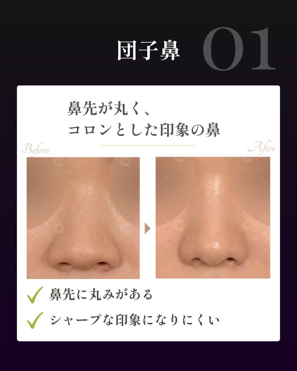 cocoline_nose's tweet photo. タイプによって必要なアプローチは全く異なります⚠️

同じ「鼻の主張を抑えたい」という悩みでも、原因が軟骨の開きなのか、皮膚や組織の厚みなのか、小鼻の横幅なのかによって適した術式は変わります。

❖ タイプ別の特徴
❶ 団子鼻：鼻先が丸くコロンとした印象（大鼻翼軟骨の配置調整） 
❷ 上がり鼻：正面から鼻孔が見えやすい（鼻尖位置の微調整・角度修正） 
❸ にんにく鼻：鼻先が丸く小鼻にも厚みがある（軟組織減量＋小鼻調整） 
❹ あぐら鼻：小鼻が横に広がっている（小鼻縮小・鼻翼幅アライメント）

「自分の鼻がどのタイプなのか」を正しく把握することが、過剰な手術を避け、顔全体になじむ自然な「忘れ鼻」を完成させる第一歩です。

自身のタイプや必要な施術を知りたい方は、お写真と一緒にご相談ください🕊️
🔗 https://t.co/bbbXCxtUeH

#韓国鼻整形 #団子鼻 #上がり鼻 #あぐら鼻 #小鼻縮小 #忘れ鼻 #ココライン美容外科 #渡韓整形