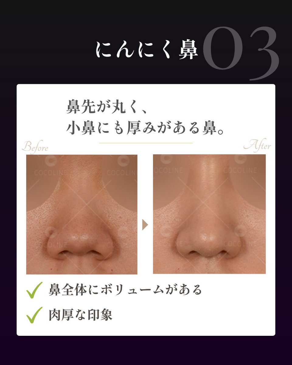 cocoline_nose's tweet photo. タイプによって必要なアプローチは全く異なります⚠️

同じ「鼻の主張を抑えたい」という悩みでも、原因が軟骨の開きなのか、皮膚や組織の厚みなのか、小鼻の横幅なのかによって適した術式は変わります。

❖ タイプ別の特徴
❶ 団子鼻：鼻先が丸くコロンとした印象（大鼻翼軟骨の配置調整） 
❷ 上がり鼻：正面から鼻孔が見えやすい（鼻尖位置の微調整・角度修正） 
❸ にんにく鼻：鼻先が丸く小鼻にも厚みがある（軟組織減量＋小鼻調整） 
❹ あぐら鼻：小鼻が横に広がっている（小鼻縮小・鼻翼幅アライメント）

「自分の鼻がどのタイプなのか」を正しく把握することが、過剰な手術を避け、顔全体になじむ自然な「忘れ鼻」を完成させる第一歩です。

自身のタイプや必要な施術を知りたい方は、お写真と一緒にご相談ください🕊️
🔗 https://t.co/bbbXCxtUeH

#韓国鼻整形 #団子鼻 #上がり鼻 #あぐら鼻 #小鼻縮小 #忘れ鼻 #ココライン美容外科 #渡韓整形