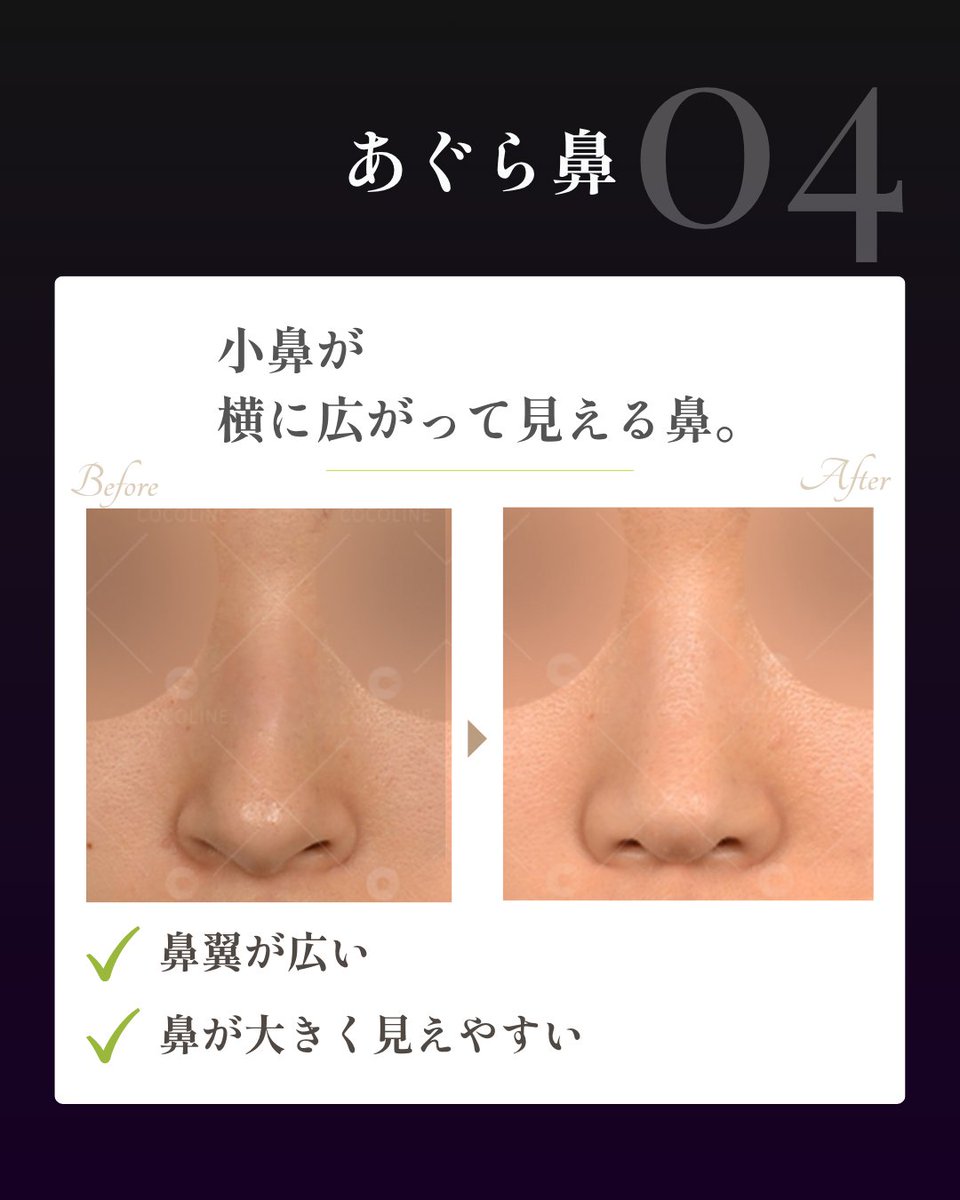 cocoline_nose's tweet photo. タイプによって必要なアプローチは全く異なります⚠️

同じ「鼻の主張を抑えたい」という悩みでも、原因が軟骨の開きなのか、皮膚や組織の厚みなのか、小鼻の横幅なのかによって適した術式は変わります。

❖ タイプ別の特徴
❶ 団子鼻：鼻先が丸くコロンとした印象（大鼻翼軟骨の配置調整） 
❷ 上がり鼻：正面から鼻孔が見えやすい（鼻尖位置の微調整・角度修正） 
❸ にんにく鼻：鼻先が丸く小鼻にも厚みがある（軟組織減量＋小鼻調整） 
❹ あぐら鼻：小鼻が横に広がっている（小鼻縮小・鼻翼幅アライメント）

「自分の鼻がどのタイプなのか」を正しく把握することが、過剰な手術を避け、顔全体になじむ自然な「忘れ鼻」を完成させる第一歩です。

自身のタイプや必要な施術を知りたい方は、お写真と一緒にご相談ください🕊️
🔗 https://t.co/bbbXCxtUeH

#韓国鼻整形 #団子鼻 #上がり鼻 #あぐら鼻 #小鼻縮小 #忘れ鼻 #ココライン美容外科 #渡韓整形