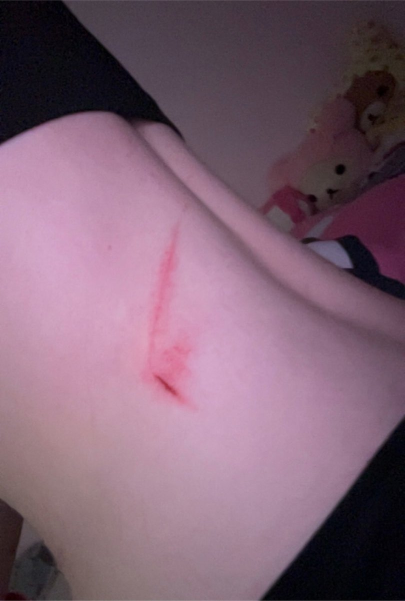 starxxchu's tweet photo. tryna figure out what the fuck i hit my back on as i went down.. came back to consciousness with this on my back and absolutely nothing around me that could’ve caused it https://t.co/7tplVIVymD