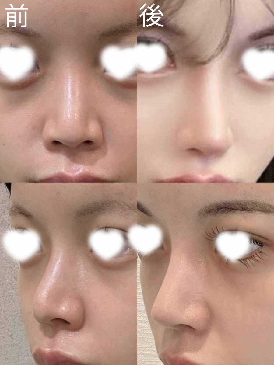 Oci13V's tweet photo. 🇰🇷ギリン美容外科で鼻フル＋目の下脂肪再配置 を受けて約半年経ちました。

仕上がりがとても自然で、違和感なく日常生活を過ごせています！😸

横顔のラインも前より綺麗になり、周りから褒められることが増えました✨
今回お願いして本当に良かったです！🤍 https://t.co/WvwOgi5MOT