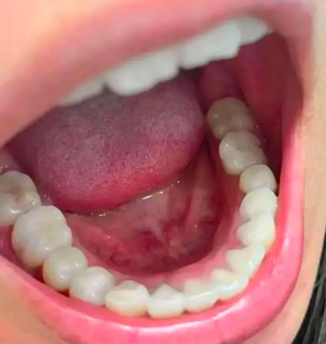 vanwillsleep's tweet photo. AUTO INSECURE gara gara gigi kuning + banyak karang giginya 😭 

Sampe akhirnya aku dikasih saran sama dentist langganan buat pake pasta gigi yang ada kandungan hydroxyapatite. Pas periksa lagi auto malah dipuji karena gigi kelihatan lebih putih dan karangnya minim 🦷✨️￼ https://t.co/3vm7hoO7aF