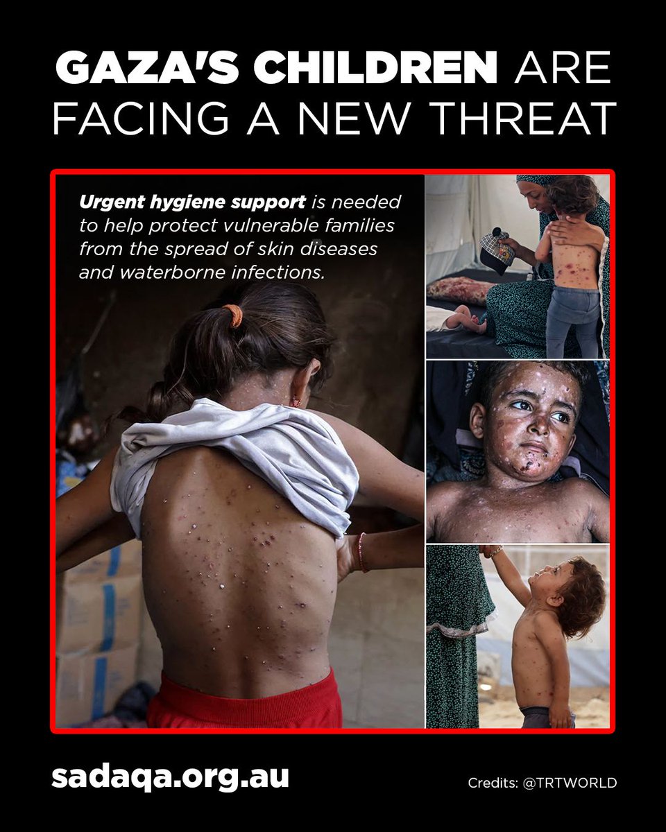 SadaqaWelfare's tweet photo. This is what the lack of basic hygiene looks like 😢

👉 Help place these vital hygiene supplies into the hands of families in Gaza using the Link https://t.co/tGXBTK6I9M https://t.co/pZZTHMM67r