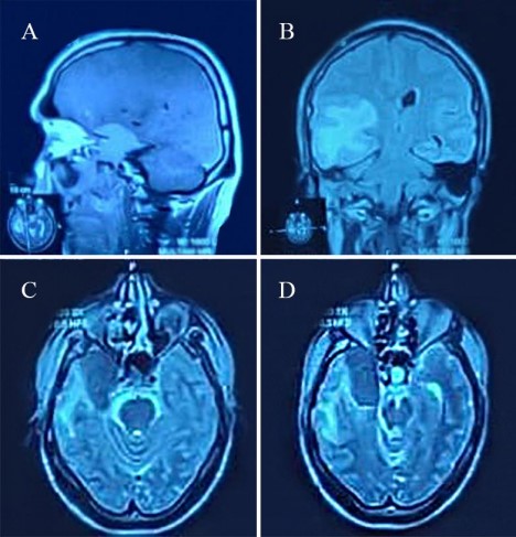 RevNeurol's tweet photo. Intracranial aspergilloma can mimic meningioma on MRI — even in immunocompetent patients. Two cases highlight the diagnostic dilemma. 👉: https://t.co/wp2JI1jt0b

#Aspergilloma #Meningioma #Neurosurgery #Neurology https://t.co/NKfJCmwwVf