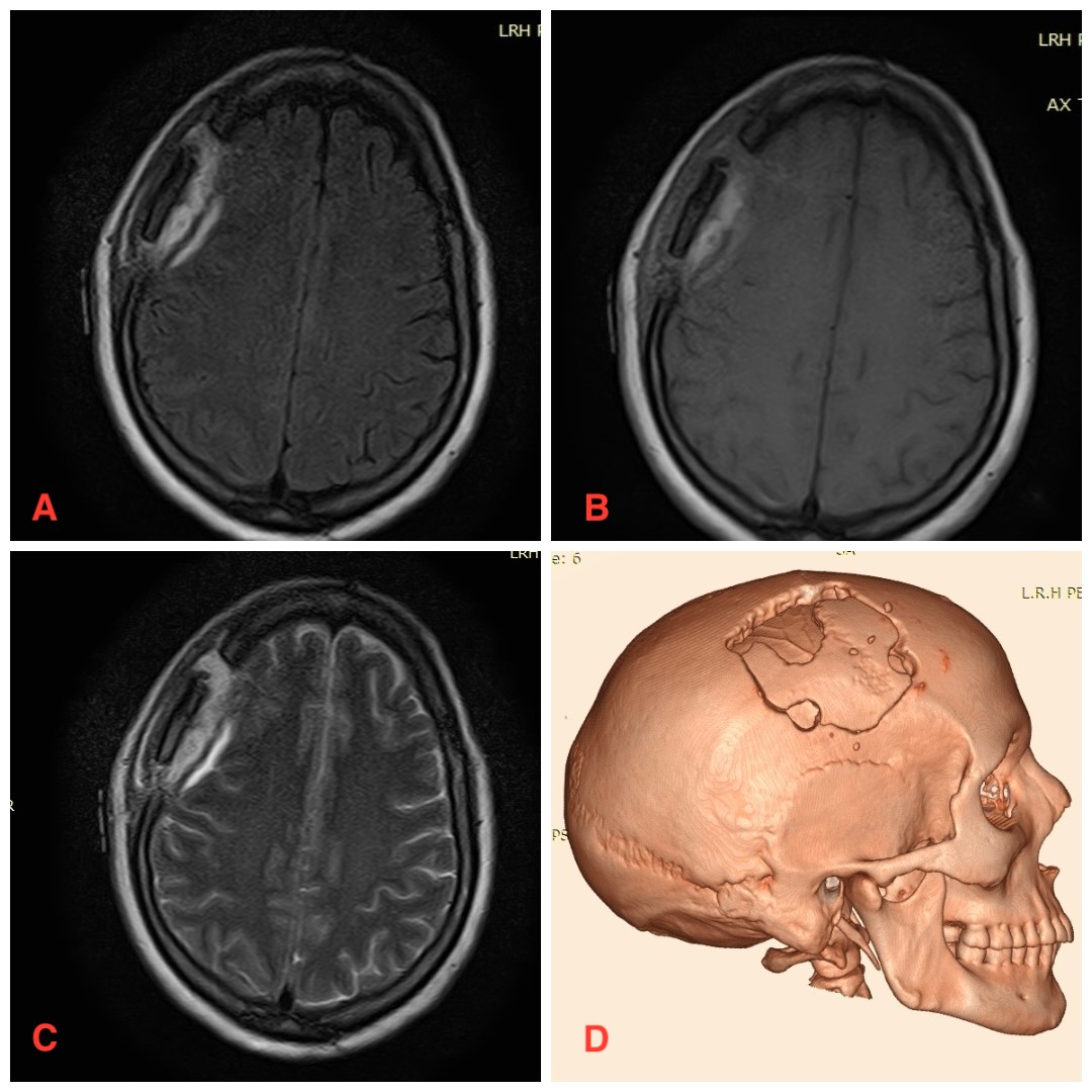 RevNeurol's tweet photo. Intracranial aspergilloma can mimic meningioma on MRI — even in immunocompetent patients. Two cases highlight the diagnostic dilemma. 👉: https://t.co/wp2JI1jt0b

#Aspergilloma #Meningioma #Neurosurgery #Neurology https://t.co/NKfJCmwwVf