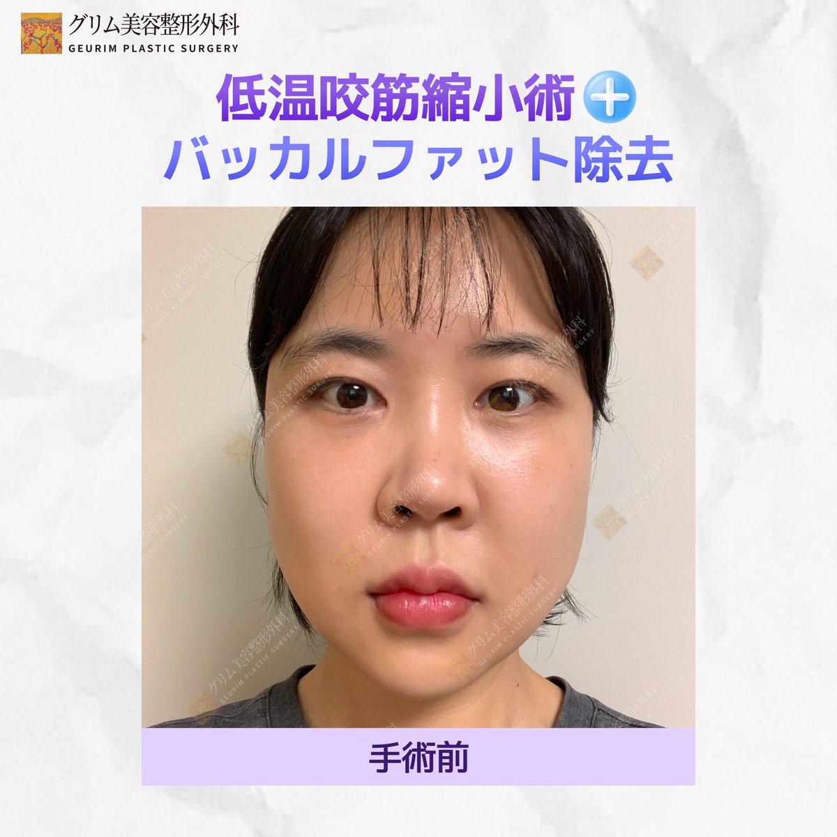 geurimjp's tweet photo. 【20代女性のリアル症例】エラ縮小（低温咬筋縮小術）× バッカルファット除去✨

「エラボトックス、何回打てば効果が出るの？」 
「定期的に通うのが面倒になってきた…」
そんなお悩みでご来院された20代のお客様のビフォーアフターをご紹介します💖

今回は、筋肉（咬筋）を半永久的に縮小させる
「低温咬筋縮小術」と、笑ったときの頬の���らみの原因「バッカルファット除去」を同時に行いました❣️

写真を見てわかる通り、下半顔の余白がギュッと小さくなり、綺麗なVラインに仕上がりました👏✨

💡こんな20代女子におすすめ🥰
🙏エラボトックスの効果が切れるのが早い 💦
🙏根本的なエラ張り解消がしたい ❣️
🙏笑ったときの「アンパンマン頬」をどうにかしたい
🙏1回の施術でしっかり効果を出したい❣️

施術の詳細やダウンタイム、費用についてはLINEからご確認ください💌 
📲 LINE ID: grkoojp https://t.co/yvQL6PhVus

#小顔効果 #エラ張り #バッカルファット #低温咬筋縮小術 #小顔整形 #ビフォーアフター写真 #20代美容 #美容皮膚科 #韓国整形 #渡韓整形 #輪郭特化 #フェイスライン #エラボトックス #Ｖライン 

 https://t.co/eAalEv1SAM #Amebaブログ #アメブロ