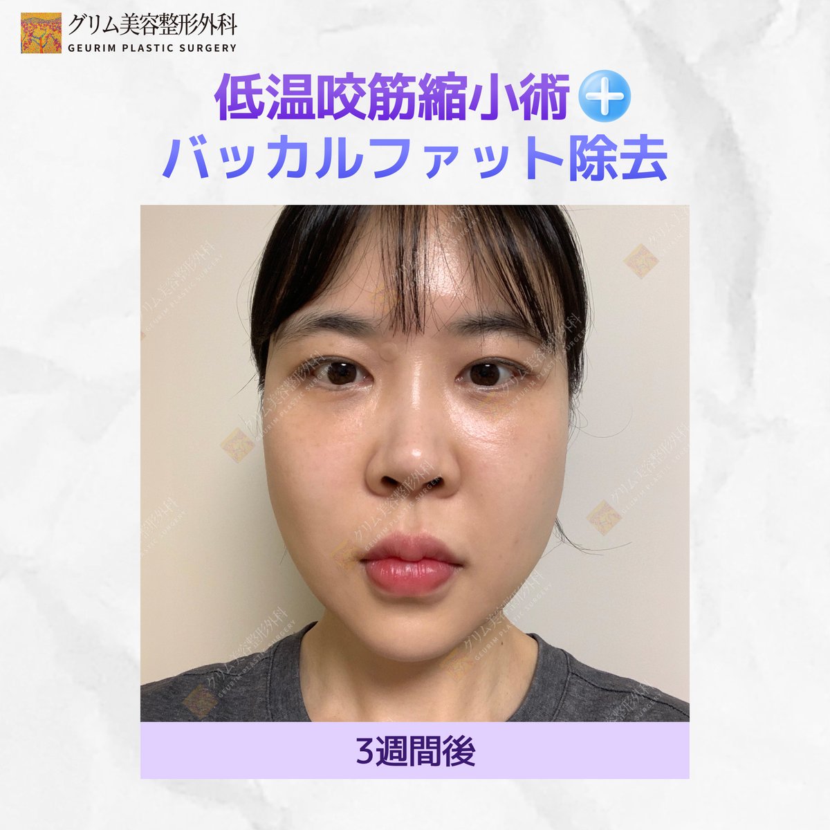 geurimjp's tweet photo. 【20代女性のリアル症例】エラ縮小（低温咬筋縮小術）× バッカルファット除去✨

「エラボトックス、何回打てば効果が出るの？」 
「定期的に通うのが面倒になってきた…」
そんなお悩みでご来院された20代のお客様のビフォーアフターをご紹介します💖

今回は、筋肉（咬筋）を半永久的に縮小させる
「低温咬筋縮小術」と、笑ったときの頬の���らみの原因「バッカルファット除去」を同時に行いました❣️

写真を見てわかる通り、下半顔の余白がギュッと小さくなり、綺麗なVラインに仕上がりました👏✨

💡こんな20代女子におすすめ🥰
🙏エラボトックスの効果が切れるのが早い 💦
🙏根本的なエラ張り解消がしたい ❣️
🙏笑ったときの「アンパンマン頬」をどうにかしたい
🙏1回の施術でしっかり効果を出したい❣️

施術の詳細やダウンタイム、費用についてはLINEからご確認ください💌 
📲 LINE ID: grkoojp https://t.co/yvQL6PhVus

#小顔効果 #エラ張り #バッカルファット #低温咬筋縮小術 #小顔整形 #ビフォーアフター写真 #20代美容 #美容皮膚科 #韓国整形 #渡韓整形 #輪郭特化 #フェイスライン #エラボトックス #Ｖライン 

 https://t.co/eAalEv1SAM #Amebaブログ #アメブロ