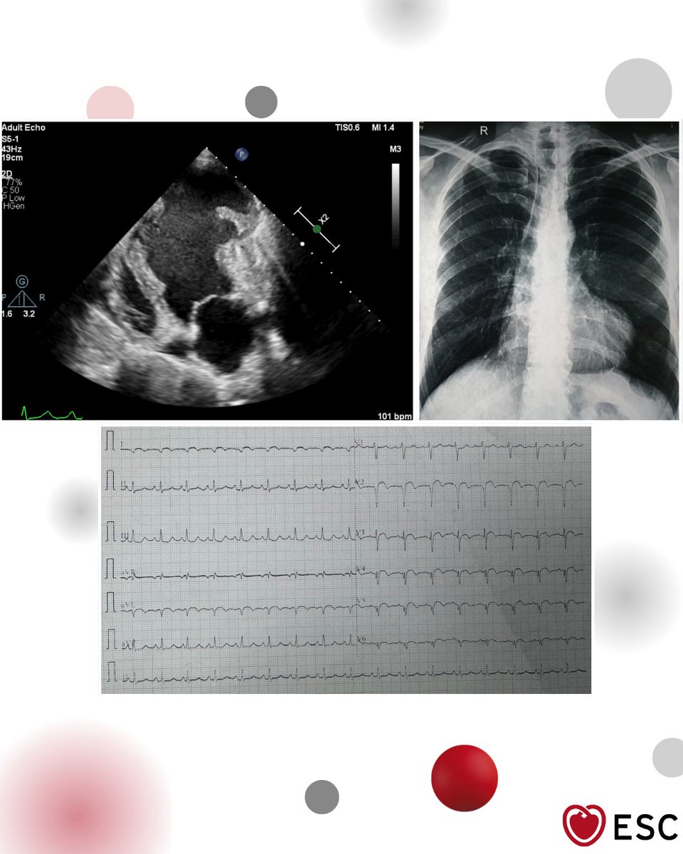 escardio's tweet photo. #ImageOfTheWeek by Kartik Aggarwal and Mohsin Raj Mantoo, All India Institute of Medical Sciences, New Delhi, India.

A 67-year-old man with no cardiovascular risk factors or prior medical history presented with chest heaviness and NYHA class II dyspnoea. 

What is the diagnosis? https://t.co/msMq59djx9