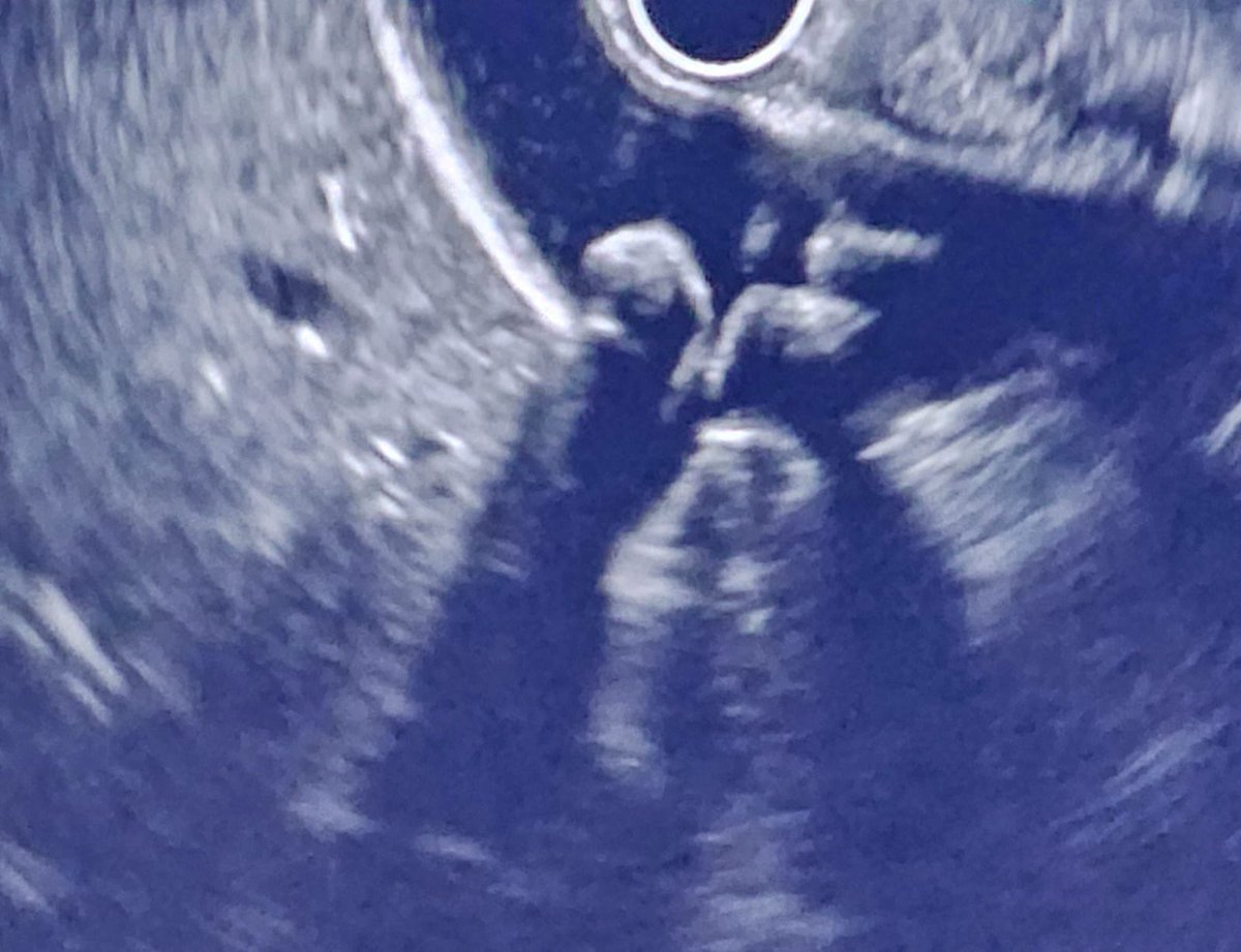 GaneshCp95's tweet photo. The little joys of an endosonologist—spotting a gallbladder stone with its classic post-acoustic shadow. 🟡🔊
#Endosonology #EUS #Gallbladder #Gallstones #Ultrasound #GIEndoscopy #AdvancedEndoscopy #MedTwitter https://t.co/lOzELiRTh9