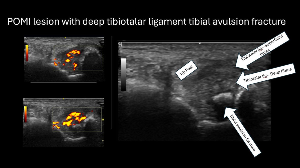 MillwardLuke's tweet photo. How often do you see a tibial avulsion fracture associated with a posteriomedial ankle impingement? Good candidate for a drop of steroid to calm the hyperaemia down followed by an onward referral to a podiatrist? 
#diagnosticultrasound #footpain #avulsionfracture https://t.co/KL3QuPq67P
