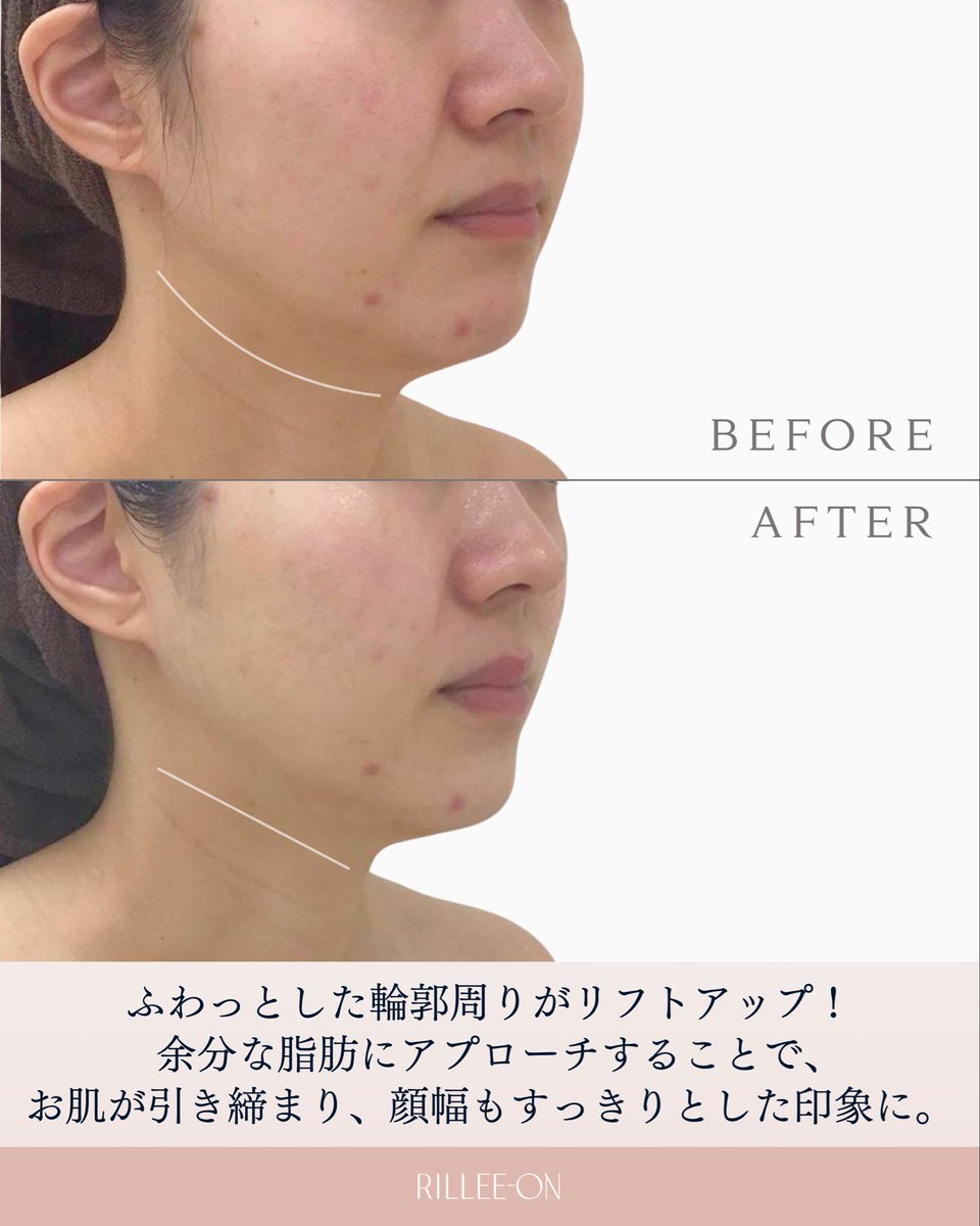 rillee_on's tweet photo. 30代のリアル変化✨ナチュラルリフトアップ

「太ったわけじゃないのに、輪郭がぼやける…」
そんな30代のお肌のもたつきをお肌の土台からケア。
自然なのにしっかり変わる、大人の小顔アプローチです。

📌今回のポイント
 ◾︎輪郭すっきり：余分な脂肪にアプローチしてお肌を引き締め、顔幅もコンパクトに。
 
◾︎頬位置UP：顎先からこめかみへ引き上げるようにケアし、立体感のある若々しい印象へ。

表面だけではなく、お肌の土台から整えてメリハリのある輪郭へ導きます✨️