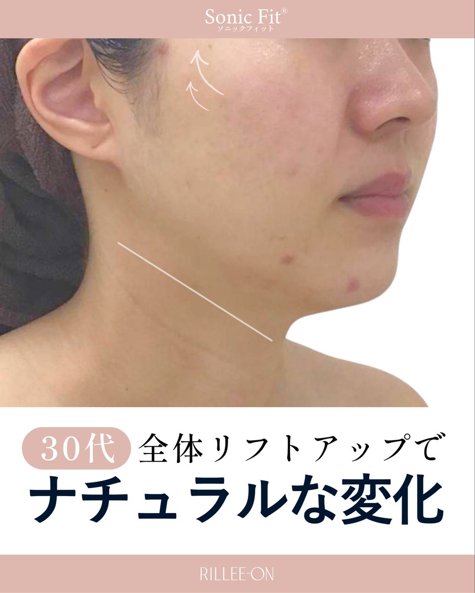 rillee_on's tweet photo. 30代のリアル変化✨ナチュラルリフトアップ

「太ったわけじゃないのに、輪郭がぼやける…」
そんな30代のお肌のもたつきをお肌の土台からケア。
自然なのにしっかり変わる、大人の小顔アプローチです。

📌今回のポイント
 ◾︎輪郭すっきり：余分な脂肪にアプローチしてお肌を引き締め、顔幅もコンパクトに。
 
◾︎頬位置UP：顎先からこめかみへ引き上げるようにケアし、立体感のある若々しい印象へ。

表面だけではなく、お肌の土台から整えてメリハリのある輪郭へ導きます✨️