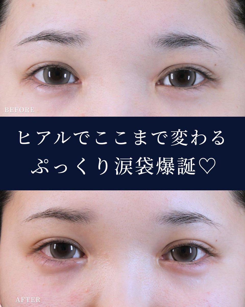 GardenClinicNet's tweet photo. 20代女性
涙袋ヒアルロン酸注入💉

施術料金：55,000円（税込）〜132,000円（税込）
※使用製剤・注入量により異なります

注意事項：腫れ、内出血、赤み、痛みなどが生じる場合がありますが、通常は数日〜2週間程度で改善します。

↓ヒアルロン酸の詳細はこちらをチェック
https://t.co/pFQTreKOQj… https://t.co/WwMfqP1NqJ