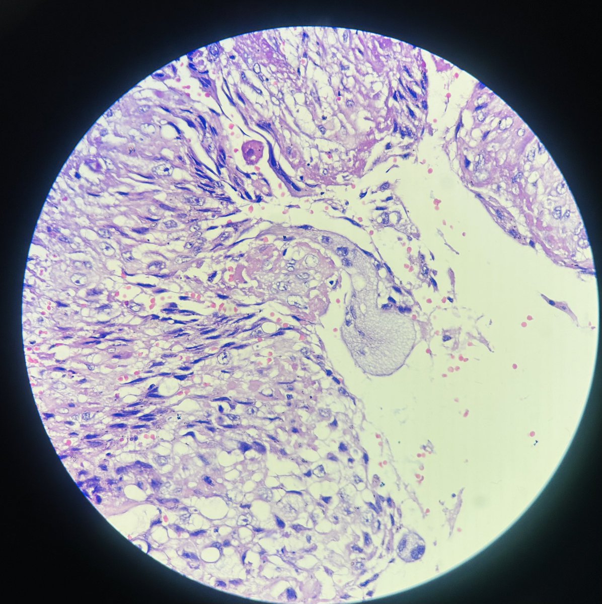 Simrangil128's tweet photo. 36 years female with right salpingectomy https://t.co/JKRDyoUf2n