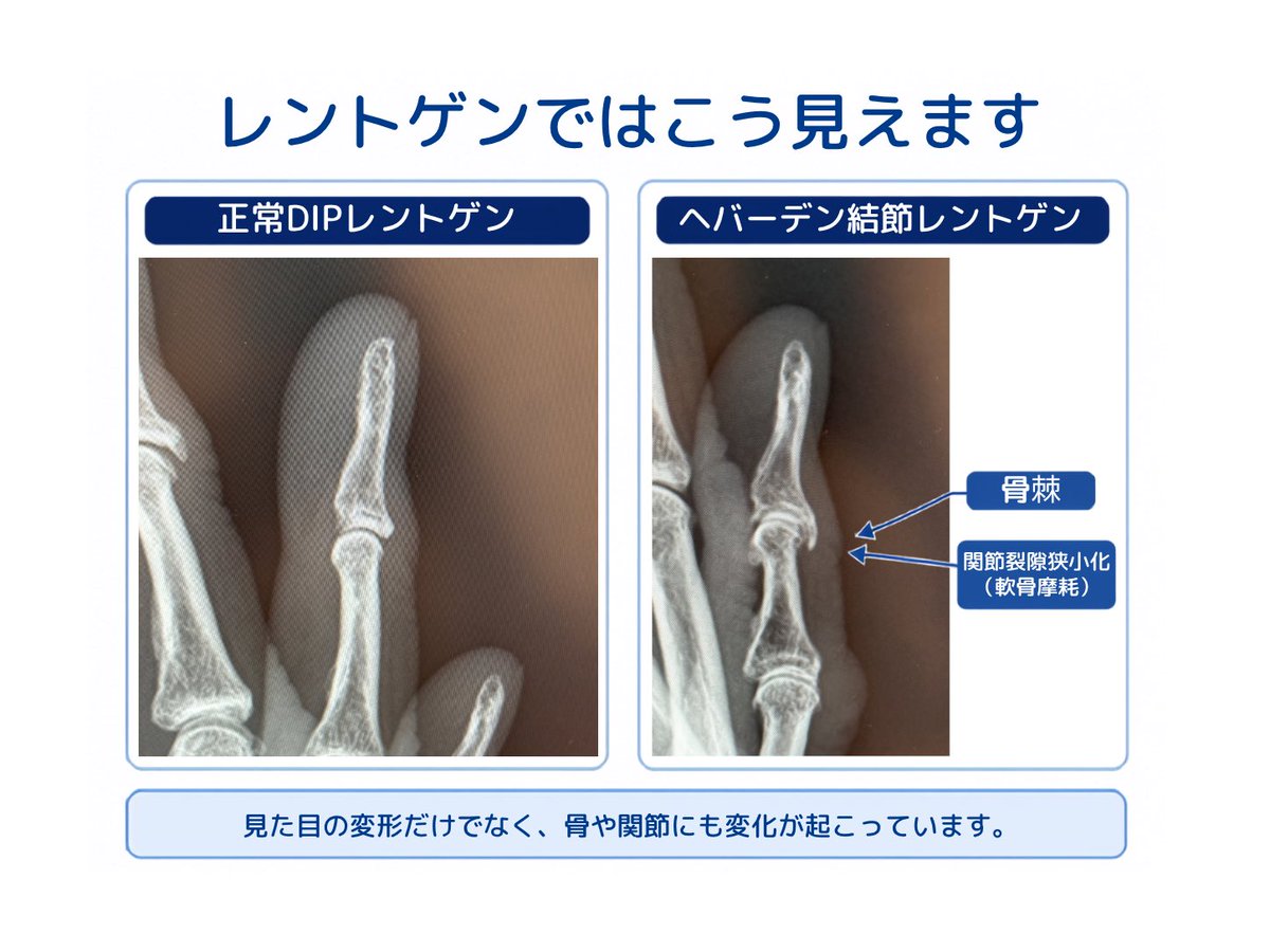 TrustTheHand110's tweet photo. 【#更年期とヘバーデン結節】

「見た目だけの病気」

ではありません。

ヘバーデン結節では、
レントゲンを撮ると
骨棘（こつきょく）や
関節の変化が見えてきます。

以前投稿した、
骨棘の変化も参考にしてみてください。👇

#ヘバーデン結節
#手外科
#更年期 https://t.co/NRoh7v2528