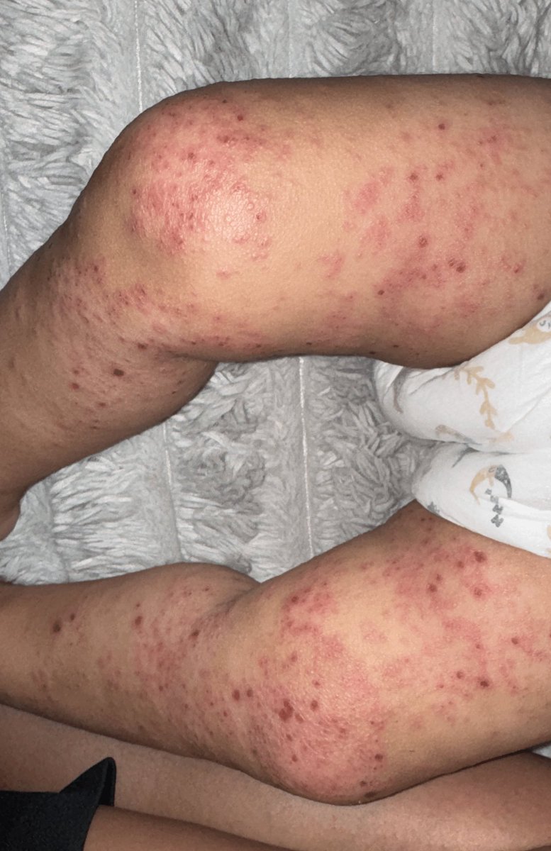 rola_almoghrabi's tweet photo. My little girl cries over and over again… she cries all day, as if the pain never gives her a moment of relief. No one feels what she is going through, and no one sees how scabies silently eats away at her small body.
😭

https://t.co/FLk3iM7URh https://t.co/t7DwtrLtjM
