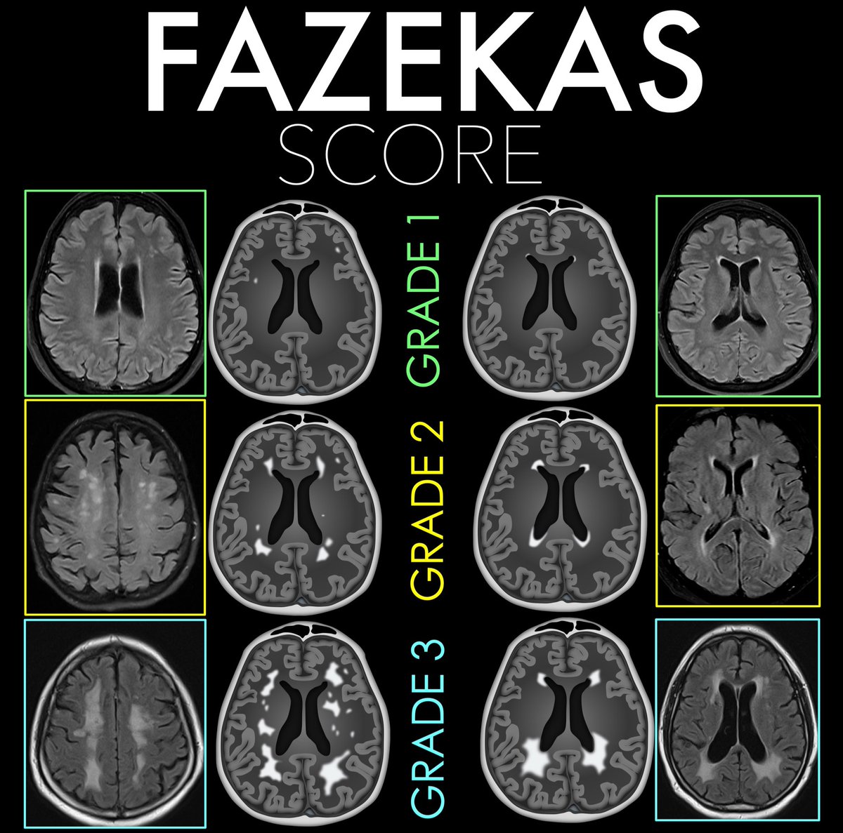 teachplaygrub's tweet photo. Feel like waving the white flag over white matter disease?

Do you grade the degree of small vessel disease, or just mention & hope no one asks for more?

Degree of small vessel disease is important & the Fazekas scale is an easy way to semi-quantitate disease burden

Here’s how to remember it:

Think about how the number looks or feels — it grows in intensity!

Deep White Matter Fazekas:
1 → “1-hit wonder”    Punctate foci — just tiny spots, like little dots.
2 → “2 = two-gether” Beginning confluence of foci — two dots coming together, mild merging.
3 → “3 is a crowd” Large, confluent areas — everything blending into a mess, too much white.

Periventricular Fazekas:
1 → “1 is a pencil” ✏️ Pencil looks a number 1 (pencil-thin “cap” or rim along ventricle).
2 → “2 curves into a halo” ⭕ Smooth halo of hyperintensity — picture the roundness of 2 encircling the ventricle.
3 → “3 branches out” 🌿 Irregular fingers of white matter reaching into the deep — the edge of the number 3 look like irregular finger

Now you know the Fazekas score for small vessel disease! 

Now your knowledge of small vessel disease will be anything but small!