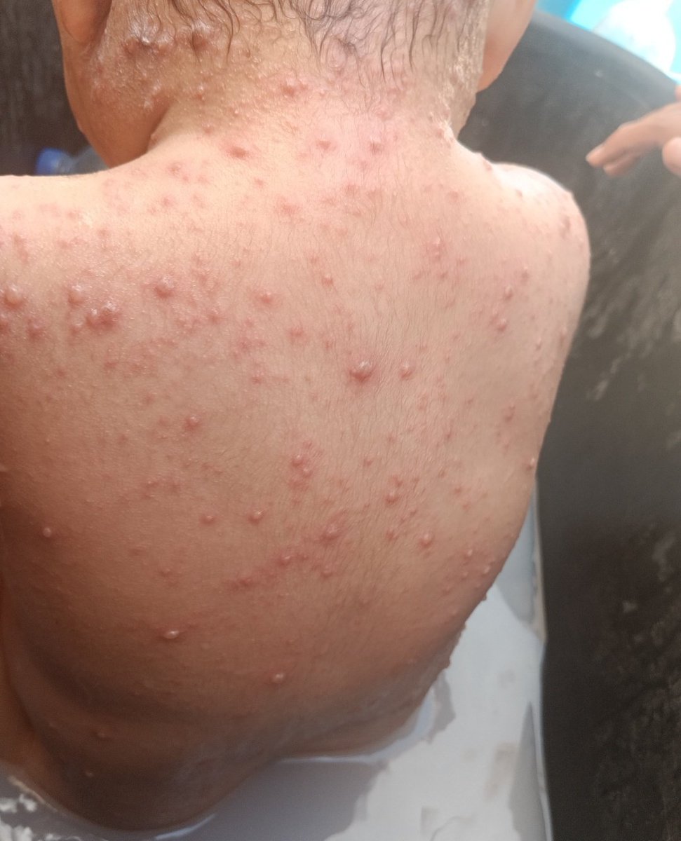 HamadDaina63593's tweet photo. Every day I call out, but no one hears me. Why is this innocent little girl being ignored? 🥺
[https://t.co/XGVG8itcBL]⬅️
My little sister, Misk, urgently needs medication after a rash spread all over her body, but the cost of her treatment is beyond my means. 💔
Please help by donating or sharing this post. Your share could reach someone who can save her.🙏💔🥺
[https://t.co/XGVG8itcBL]⬅️